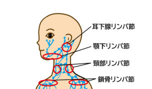 【質問】首のリンパが腫れる菊池病 ( 壊死性リンパ節炎 ) の症状・原因・予防法とは？＜鍼灸・栄養療法の体質別アプローチで改善へ＞