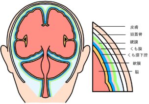 [硬膜下血腫] 急性・慢性硬膜下血腫の比較 ( 予防策付き拡張版 )